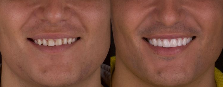 Antes — Diseño de Sonrisa Completo
