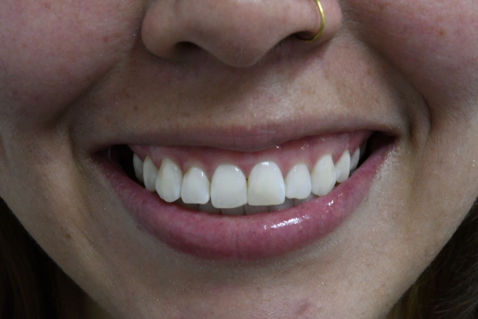 Antes — Blanqueamiento + Tratamiento de sonrisa gingival con Botox