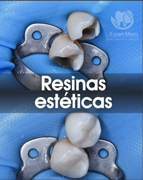 Restauración con resinas estéticas — antes y después